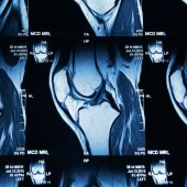 NexGen Faulty Knee Implant Recall